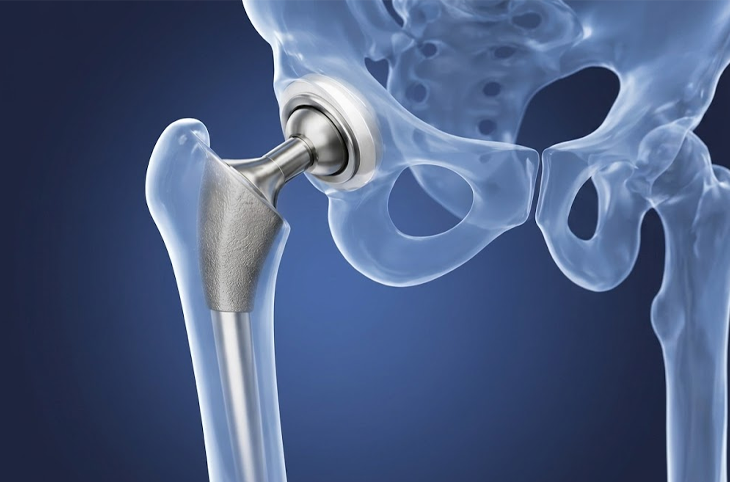 hip-replacement-2 What is Hip Replacement Surgery?