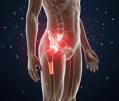 Revision Hip Replacement in Ahmedabad